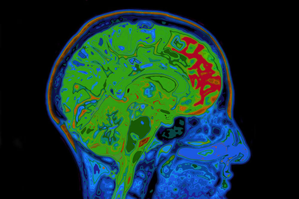 Understanding Frontotemporal Dementia
